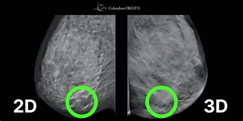 columbus mammography center|Mammograms in Columbus, Ohio .